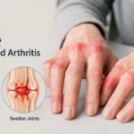 RA Mean in Medical Terms